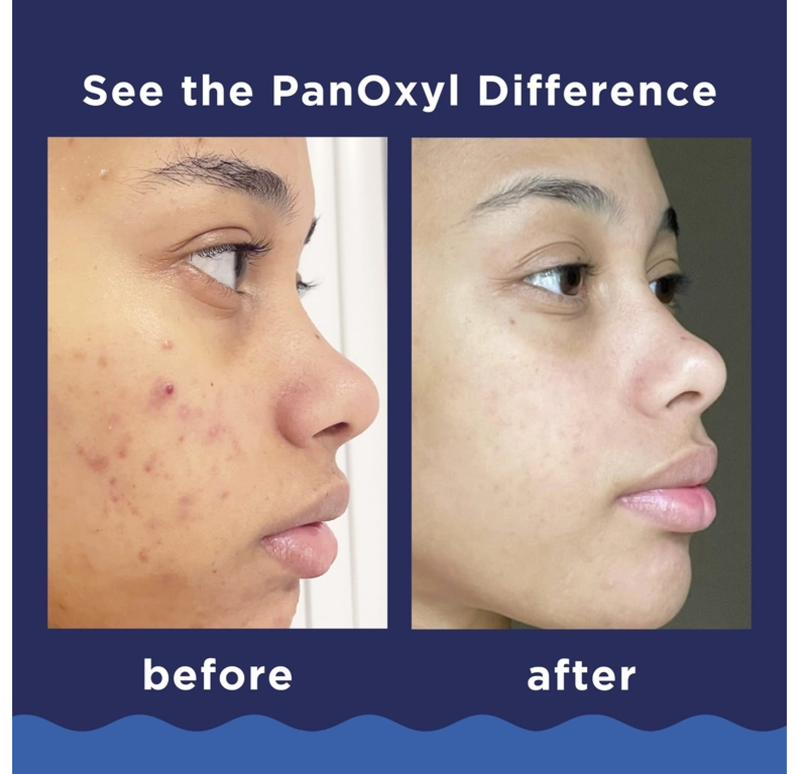 PanOxyl, очищающая пенка от акне, для лица и тела, максимальная эффективность, 85 г (3 унции)